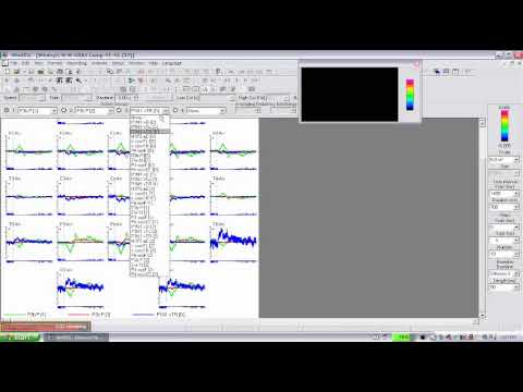 WinEEG education video Part 3